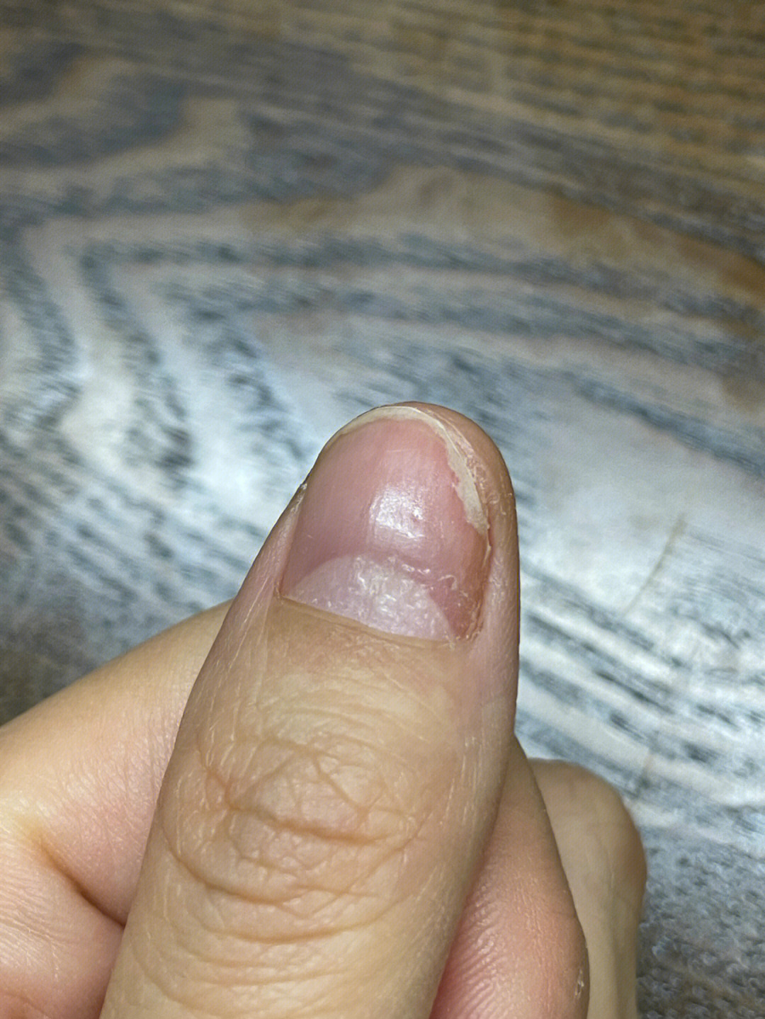 指甲底部出现了白点点,凹凸不平的以为是灰