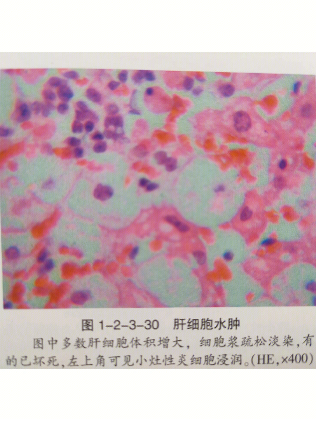 不是嗜酸小体)图二:肝细胞变性包括细胞含