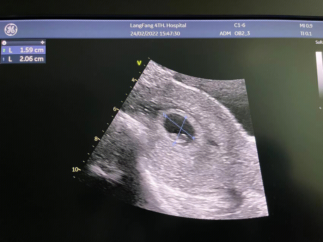 三个月的孕囊形状图片图片
