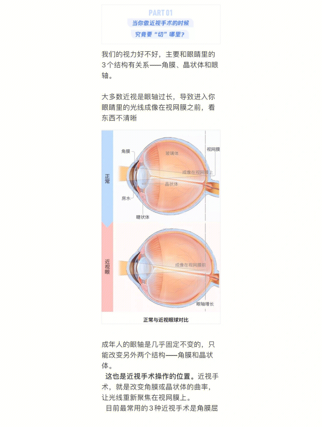 近视手术小课堂