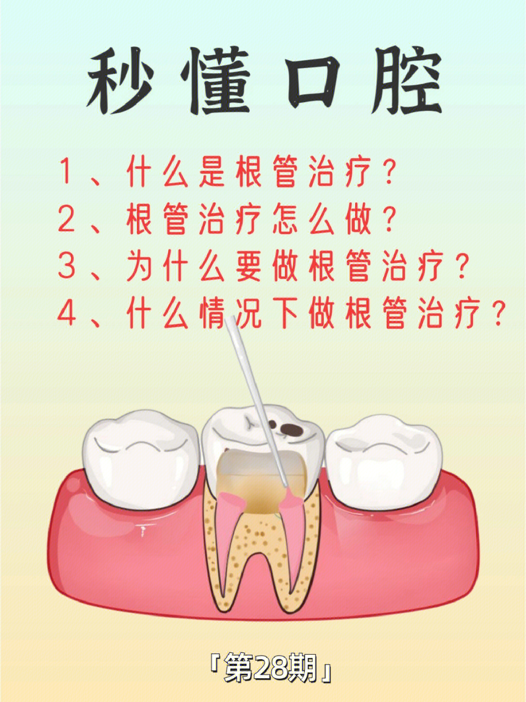 牙齿根管治疗步骤图片