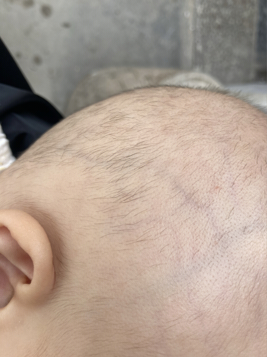 宝宝7个月这种稀稀拉拉几根头发