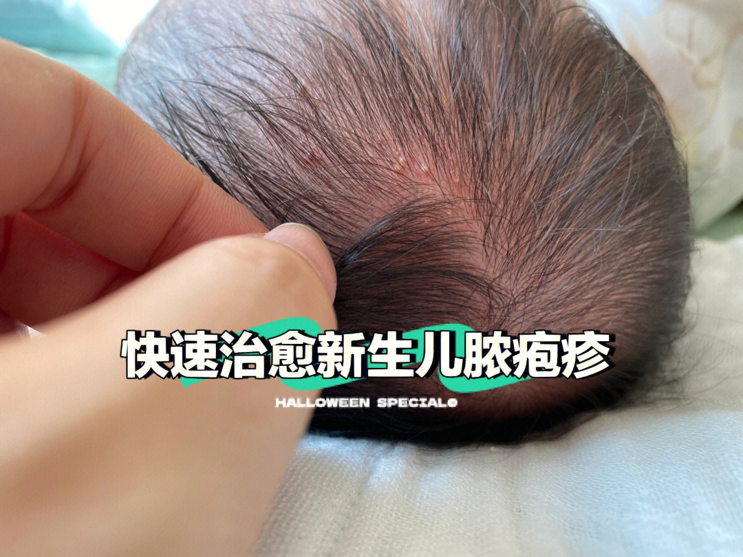 新生儿脓疱疹图片
