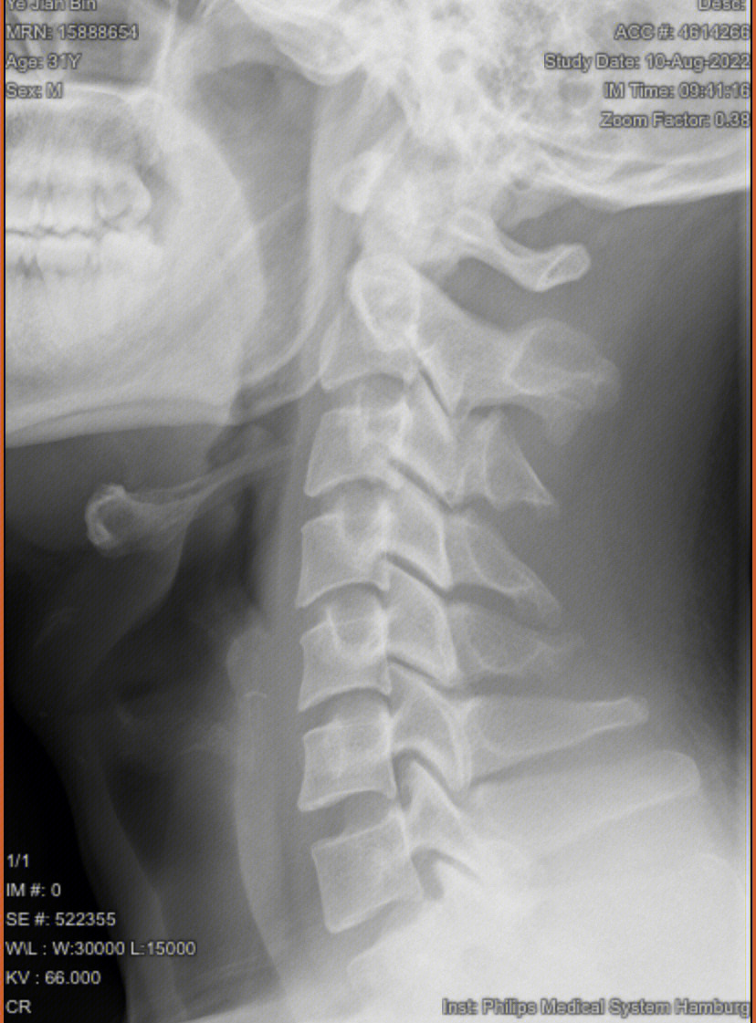 颈椎病有会看x片的吗磁共振轻微突