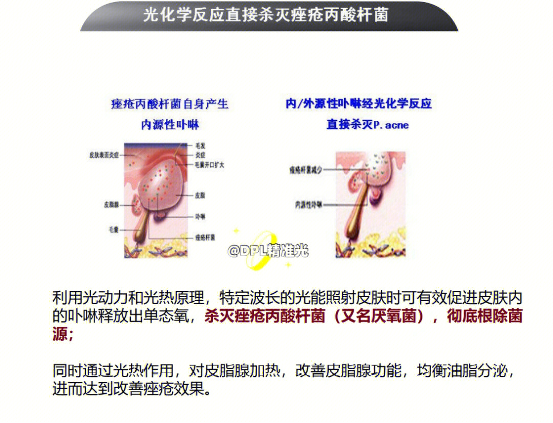 光子嫩肤原理科普