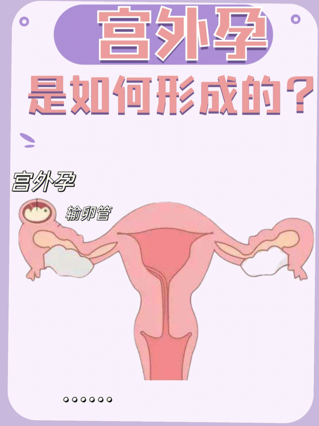 受精卵在子宫体腔以外着床称为异位妊娠,习称宫外孕