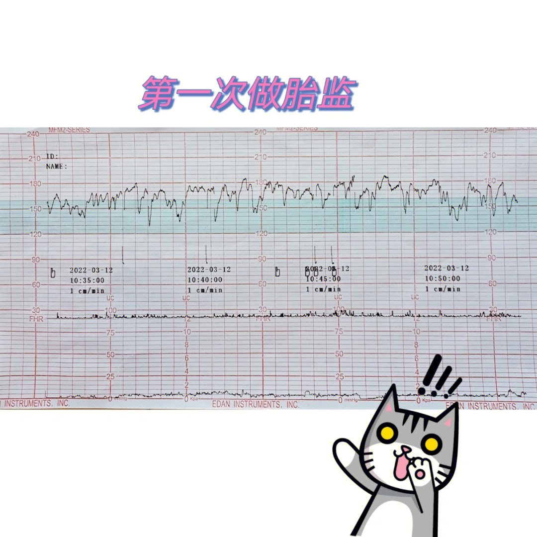 胎心监护图解析图片