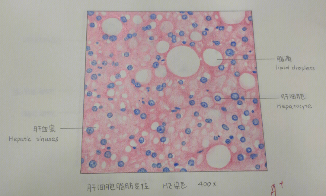 慢性肝淤血切片手绘图图片