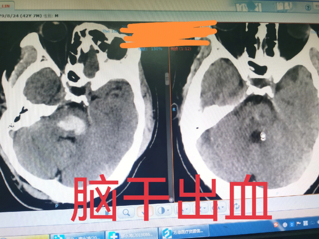 脑干出血死亡率图片