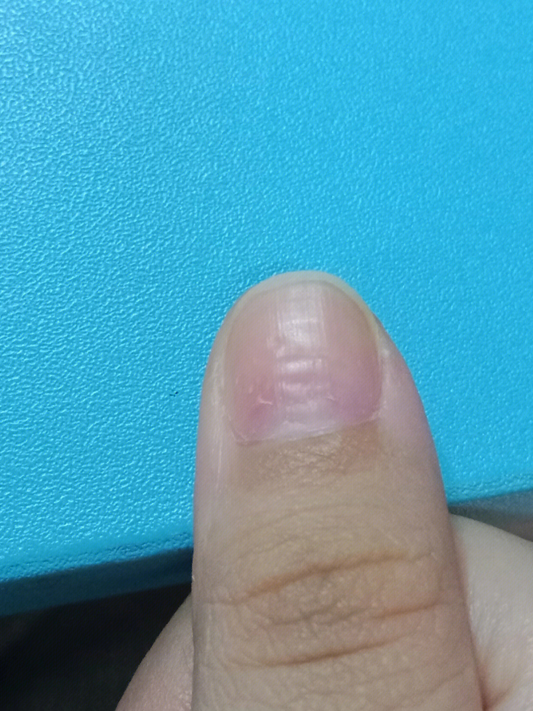 大拇指指甲盖凹凸不平是怎么回事