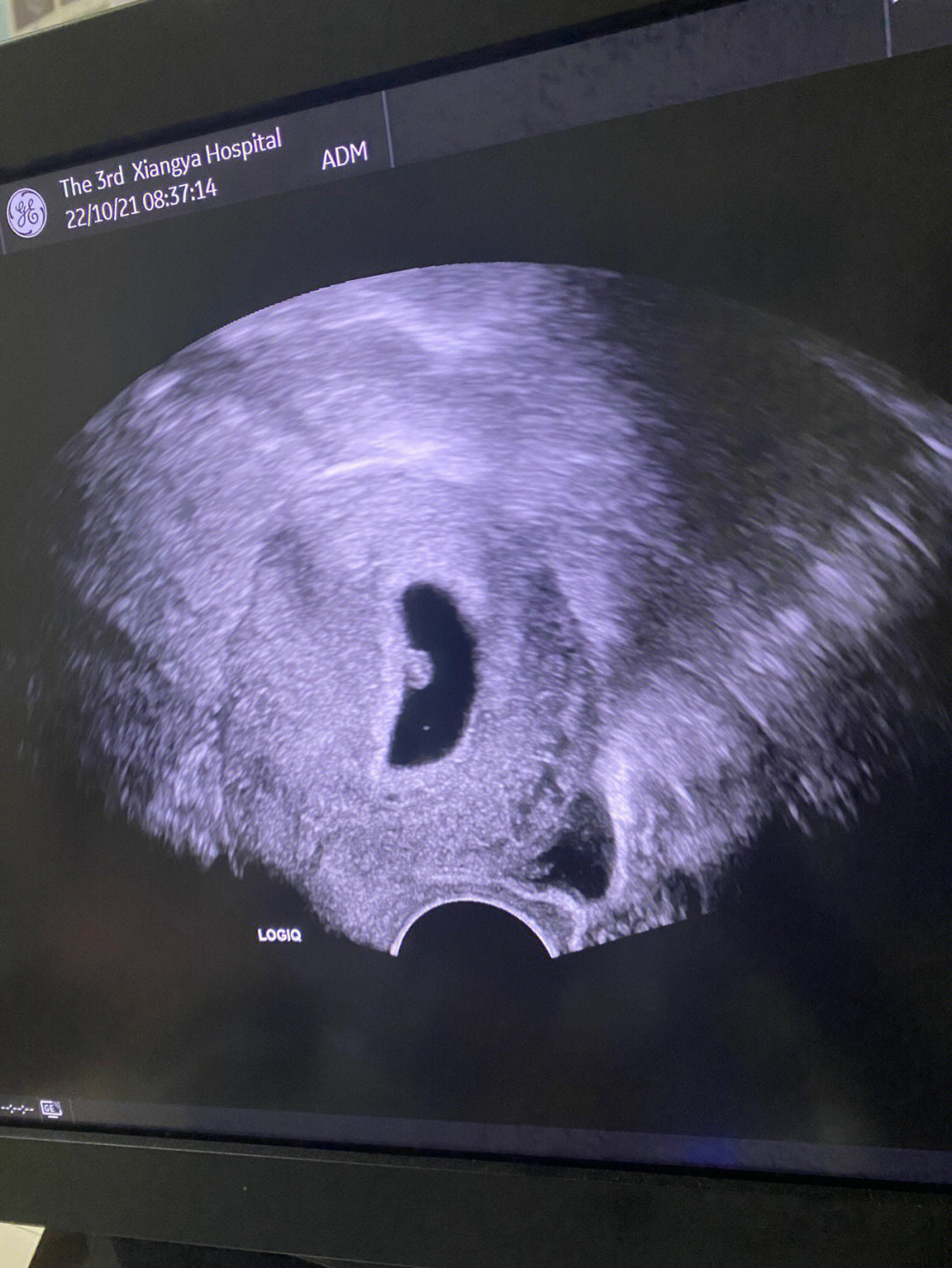 胎心胎芽图图片
