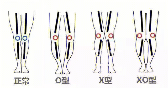 腿型问题大诊断90