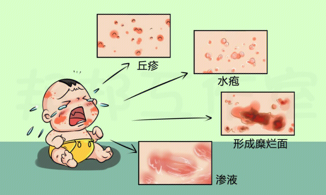 新生儿湿疹的原因图片