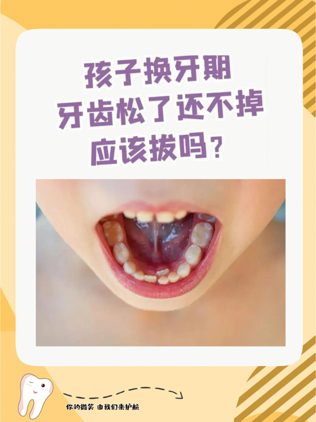 06稍不留意就导致恒牙萌出乳牙滞留(双排牙)06后期导致牙齿不齐!