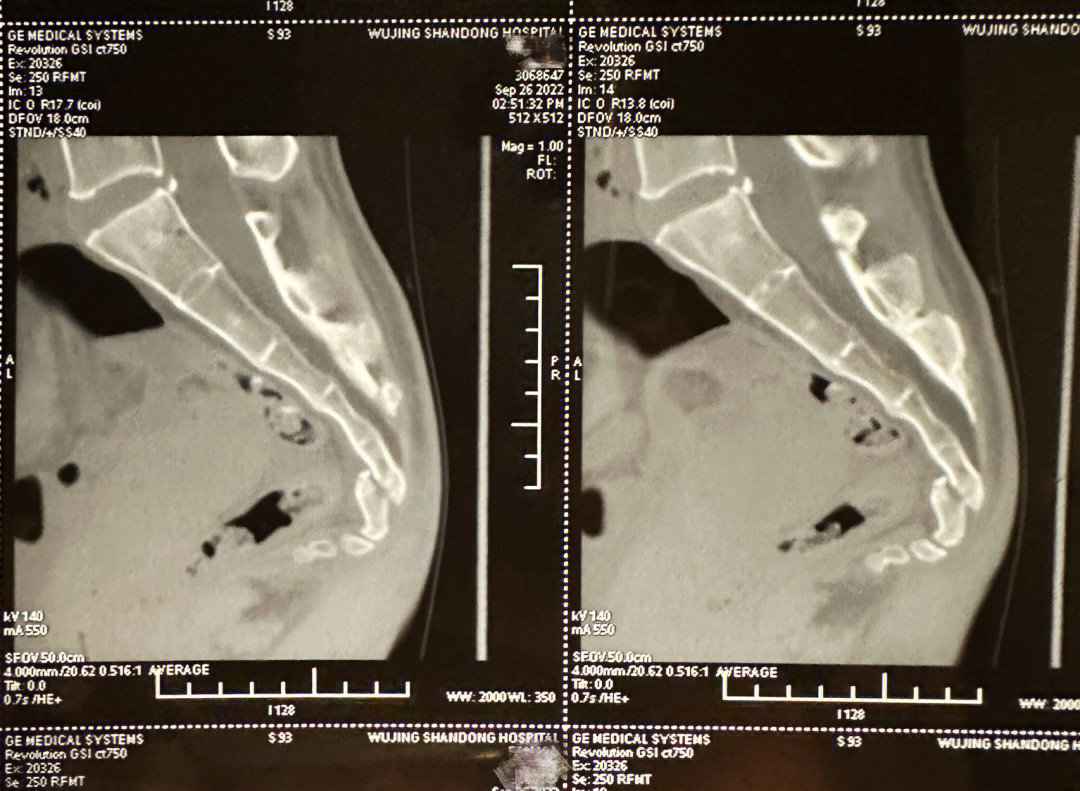 女人骶5椎体骨折图片图片