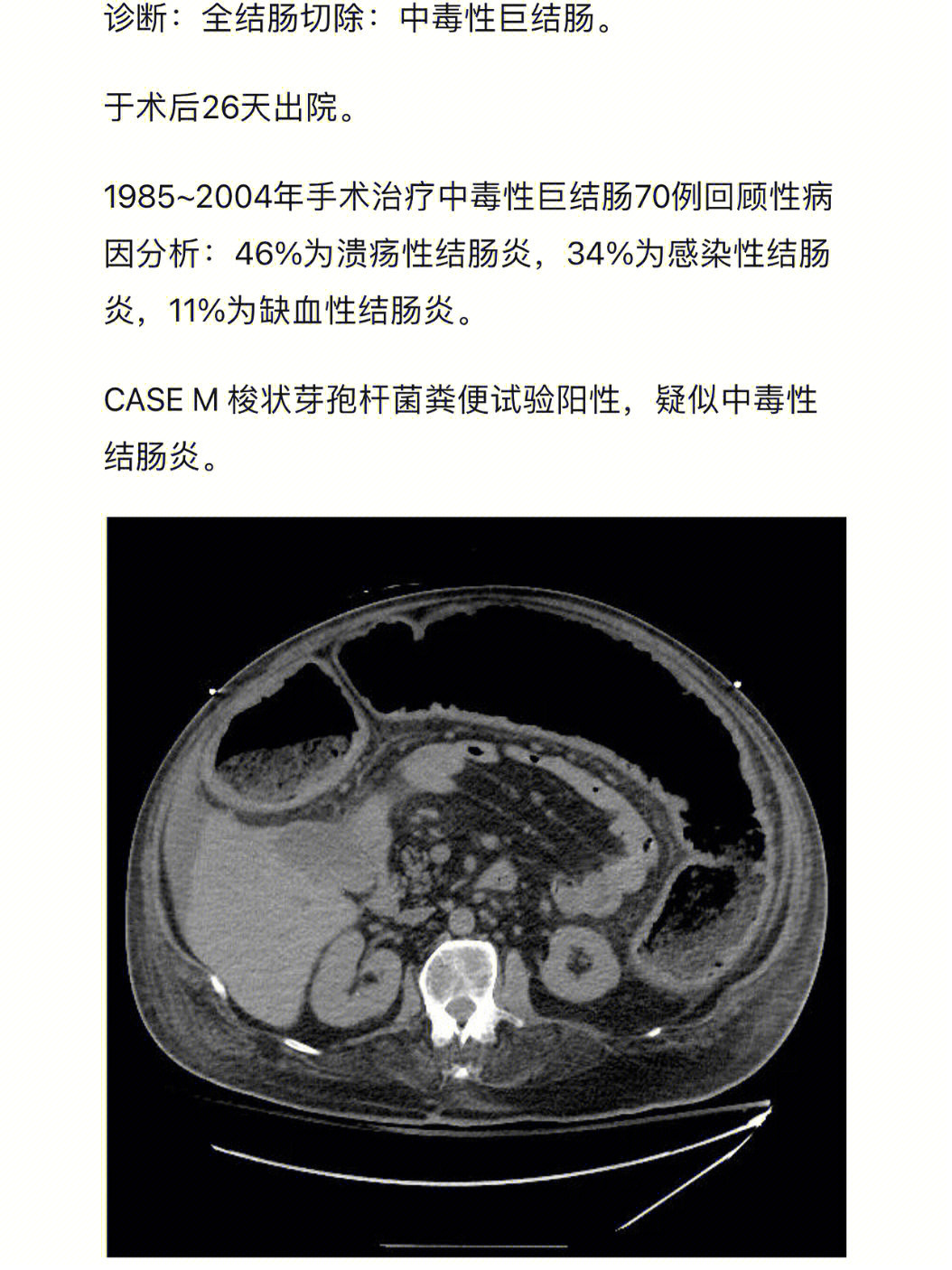 巨结肠分型图片