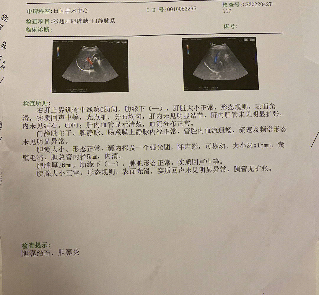 肝内胆管结石超声报告图片