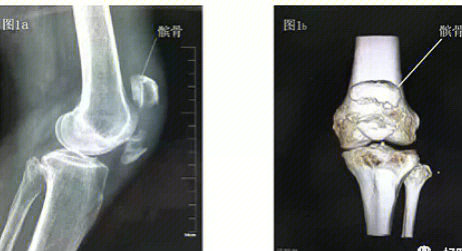 髌骨骨折手术后折线图图片