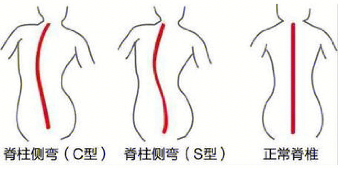 脊椎旋转比侧弯麻烦图片