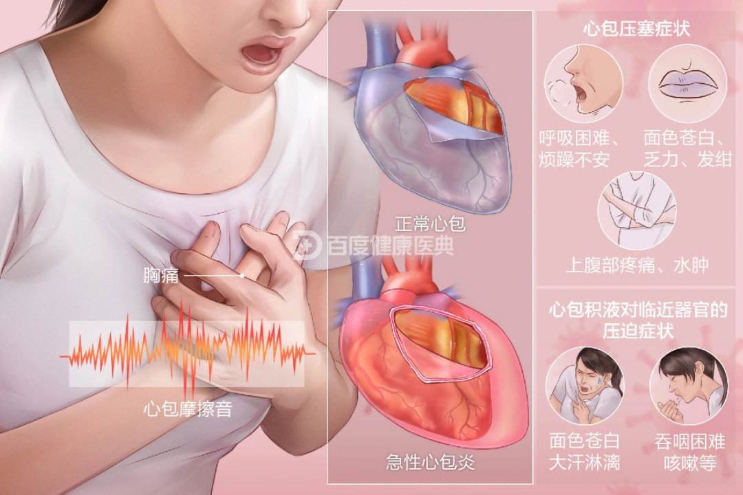 性心包炎是心脏脏层和壁层的急性炎症性疼痛病因:最常见病毒感染临床