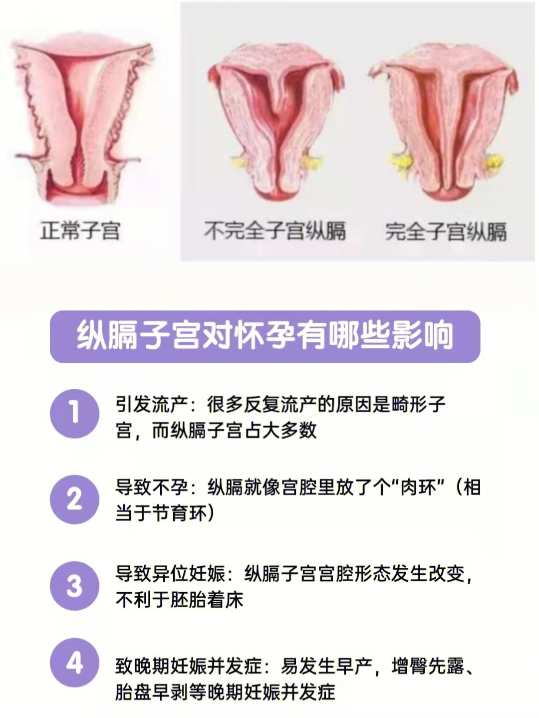 不全纵隔子宫y型图片