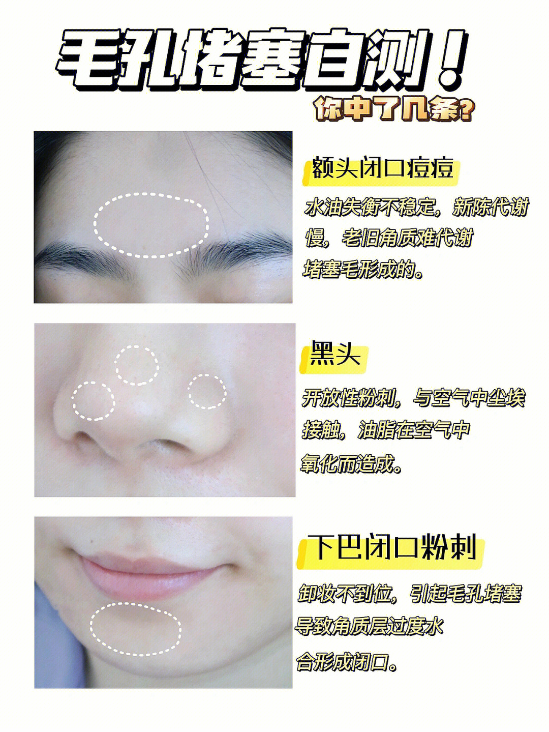 黑头闭口粉刺的区别图片