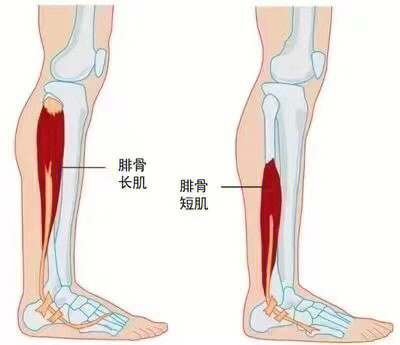 腓骨肌腱脱位示意图图片