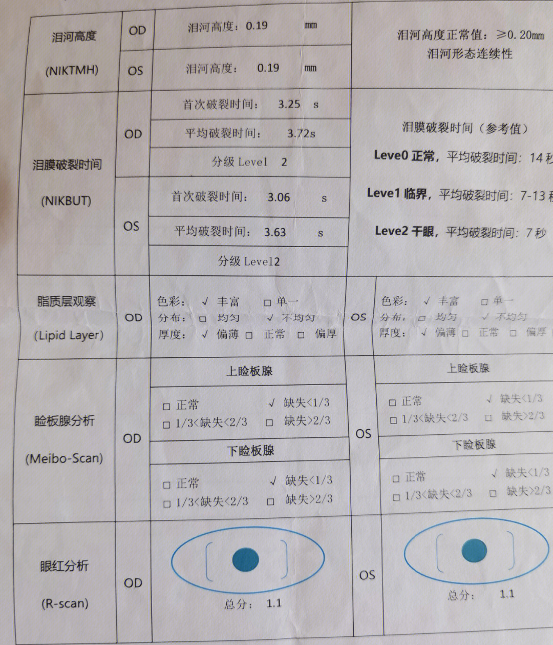 干眼症病例图片