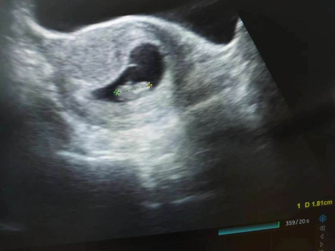 胎芽胎心放大图片图片