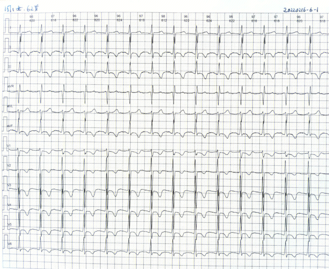 心电图P112ms图片