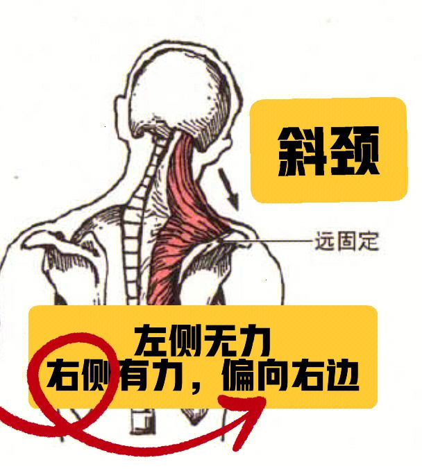 生理性斜颈图片