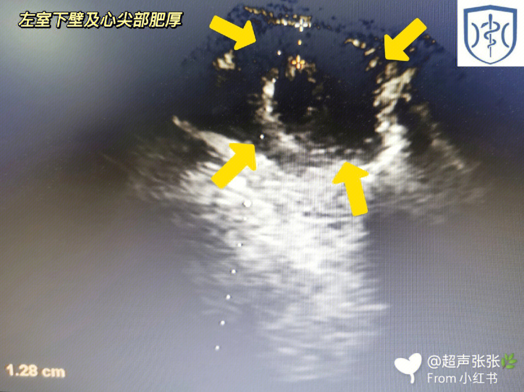 心脏超声肥厚型心肌病左室下段及心尖