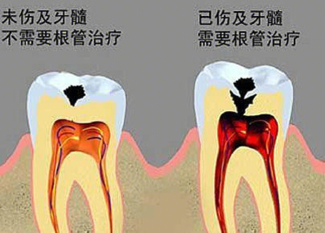 根管治疗要几次图片