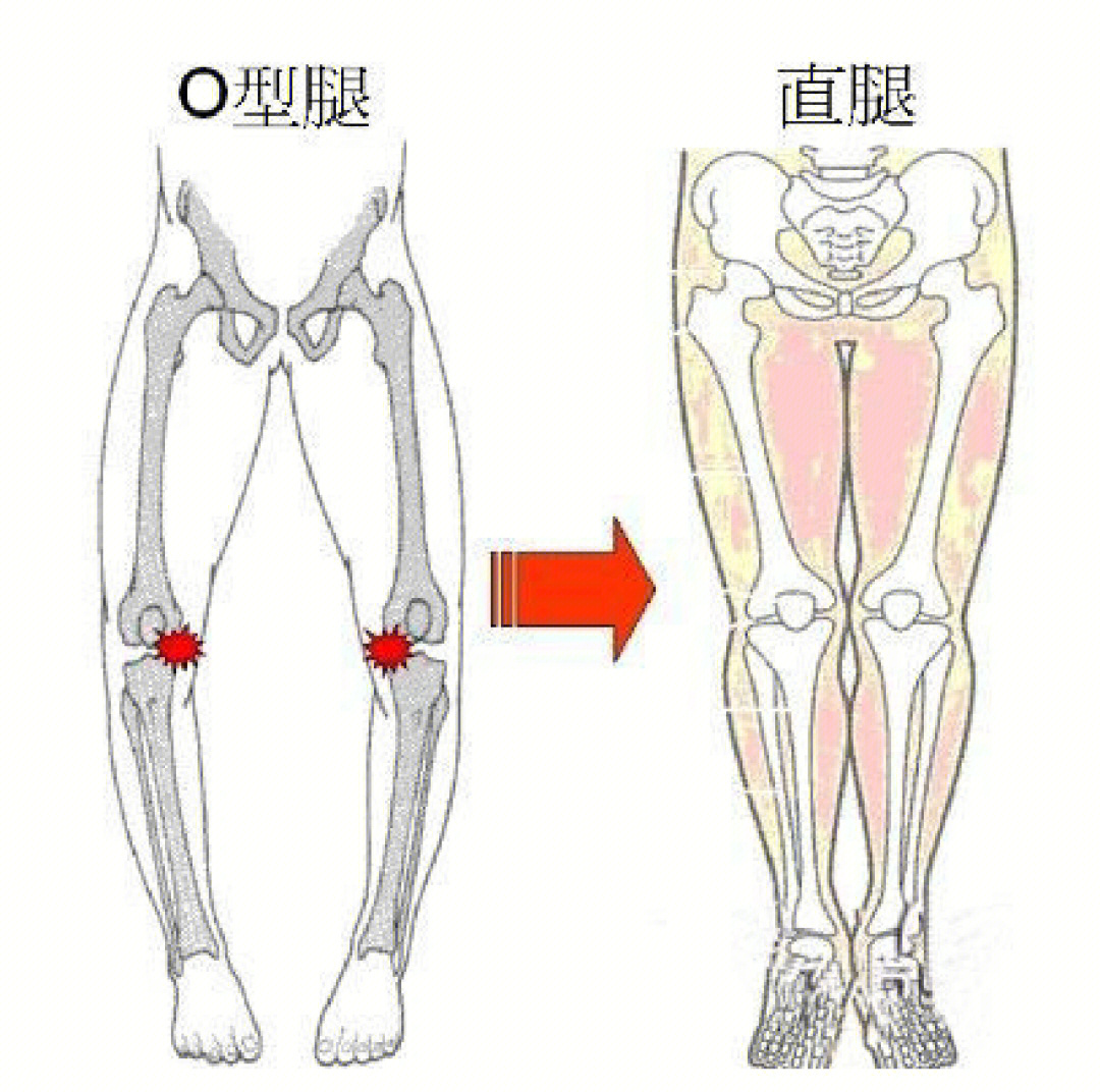 内翻并且股骨同步内旋,也会形成o型腿,也叫内股o股骨内旋下,胫骨外旋