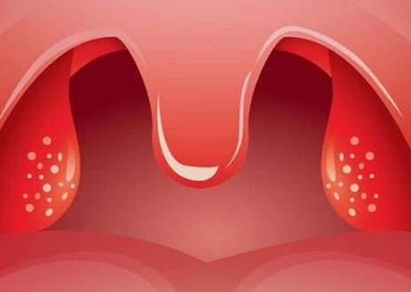 扁桃体炎是一种非特异性急性炎症,本病发病率高,并发症较多,易复发
