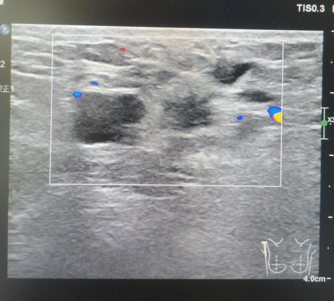 腋下淋巴结彩超图片