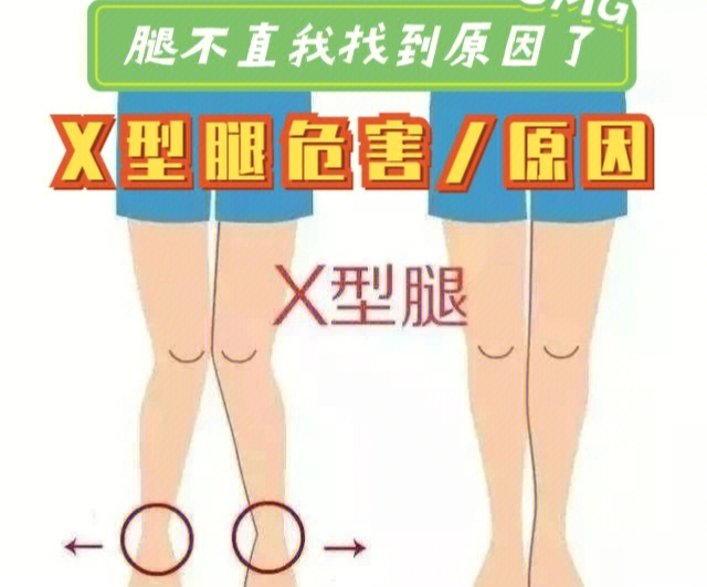 x型腿怎么造成的图片