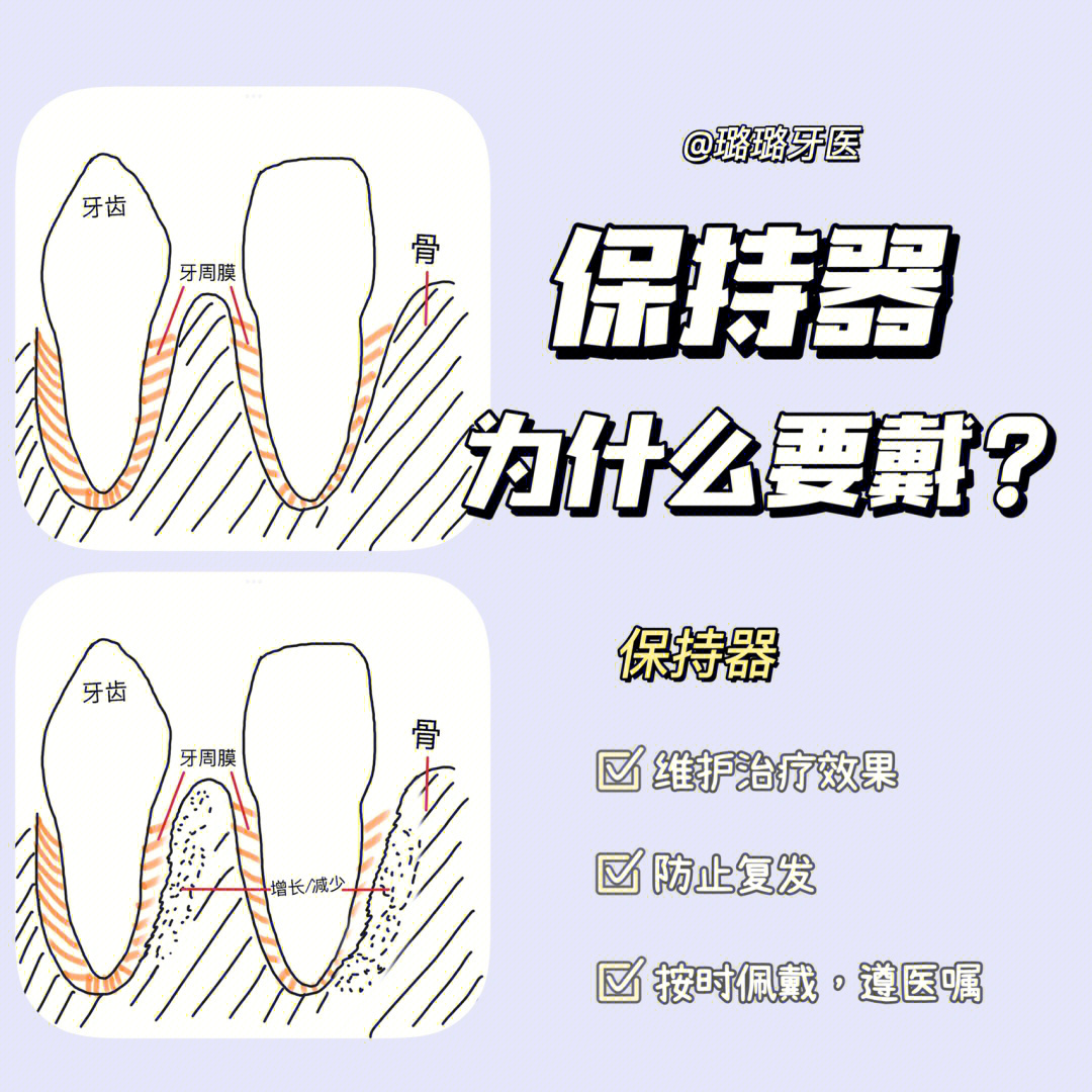 保持器要戴多久图片