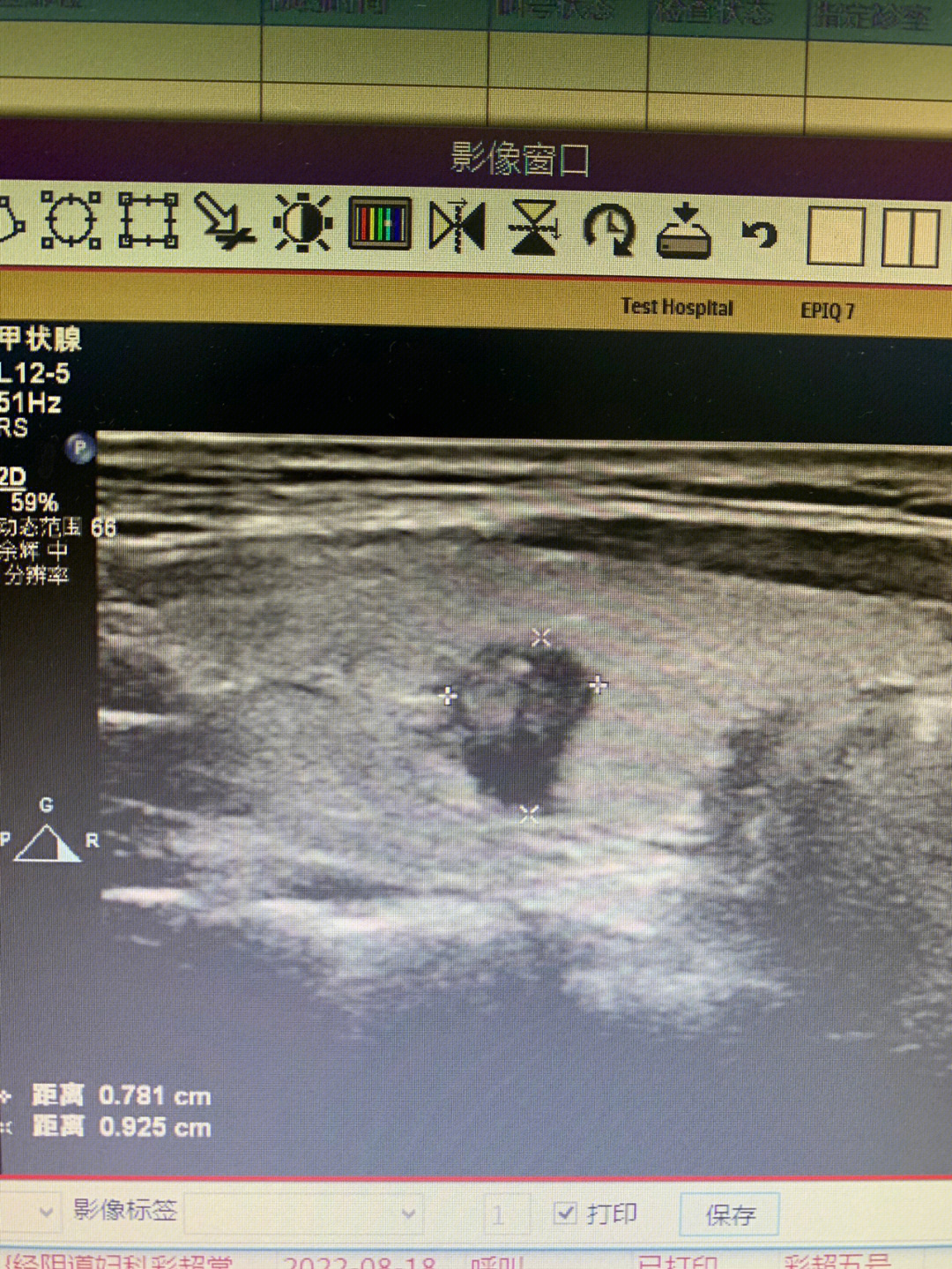 甲状腺癌ct病例图片图片