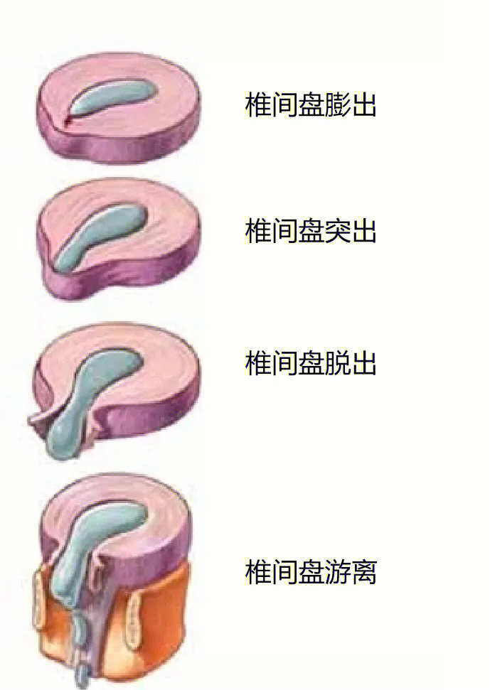 腰椎间盘突出症分型:膨出,突出,脱出,游离(图1-2)腰椎间盘突出症症状