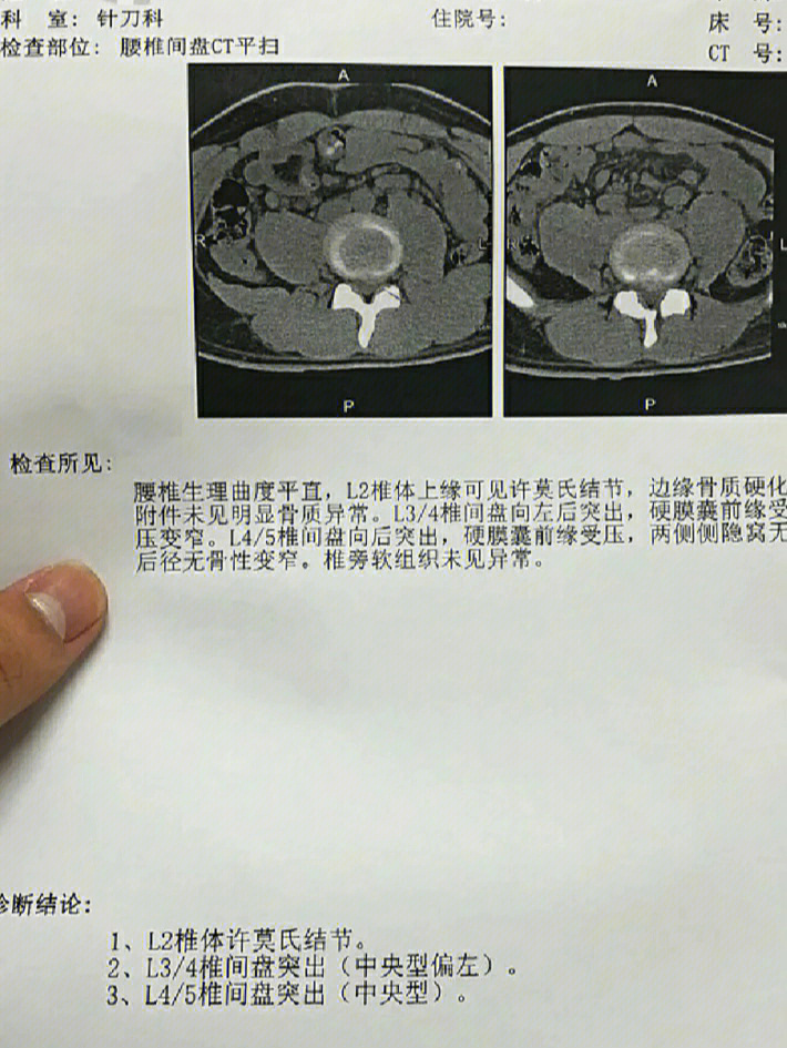 手把手教你怎么改78善腰椎间盘突出快学起