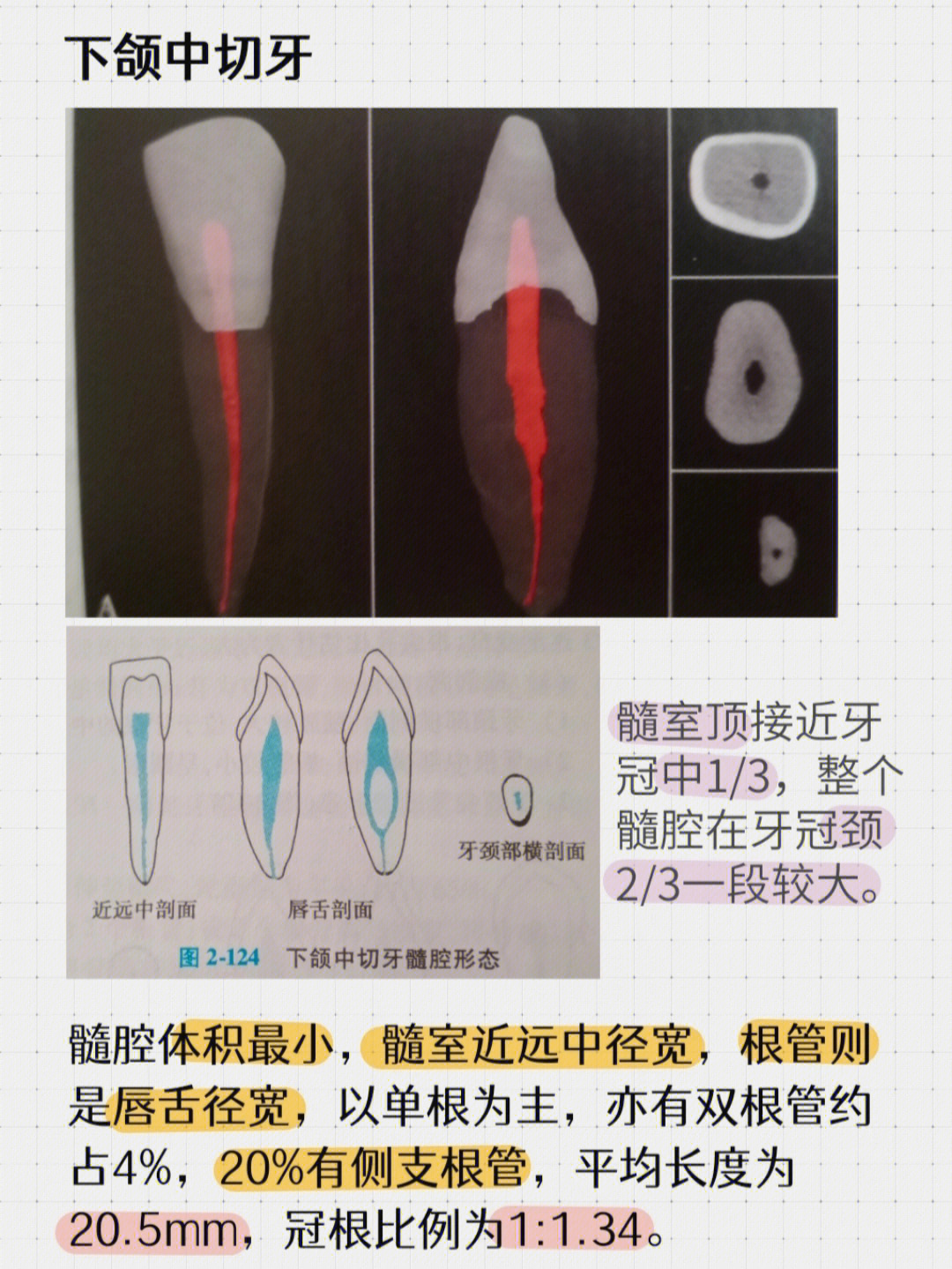 下颌6根管口分布图图片