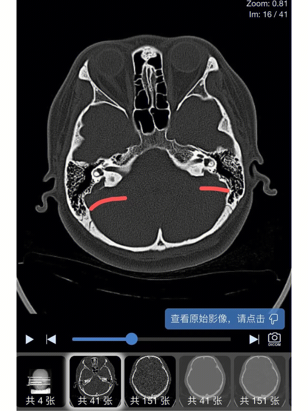 前庭大腺癌图片图片