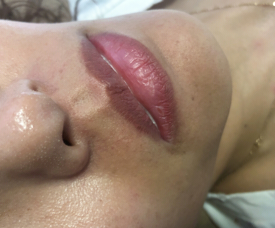 6个月宝宝下唇有淤紫图片