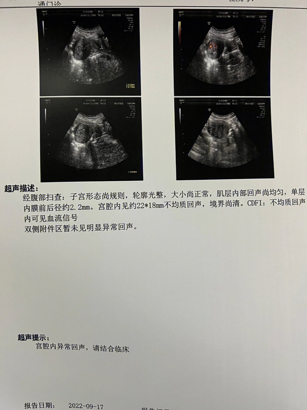 药流诊断图片