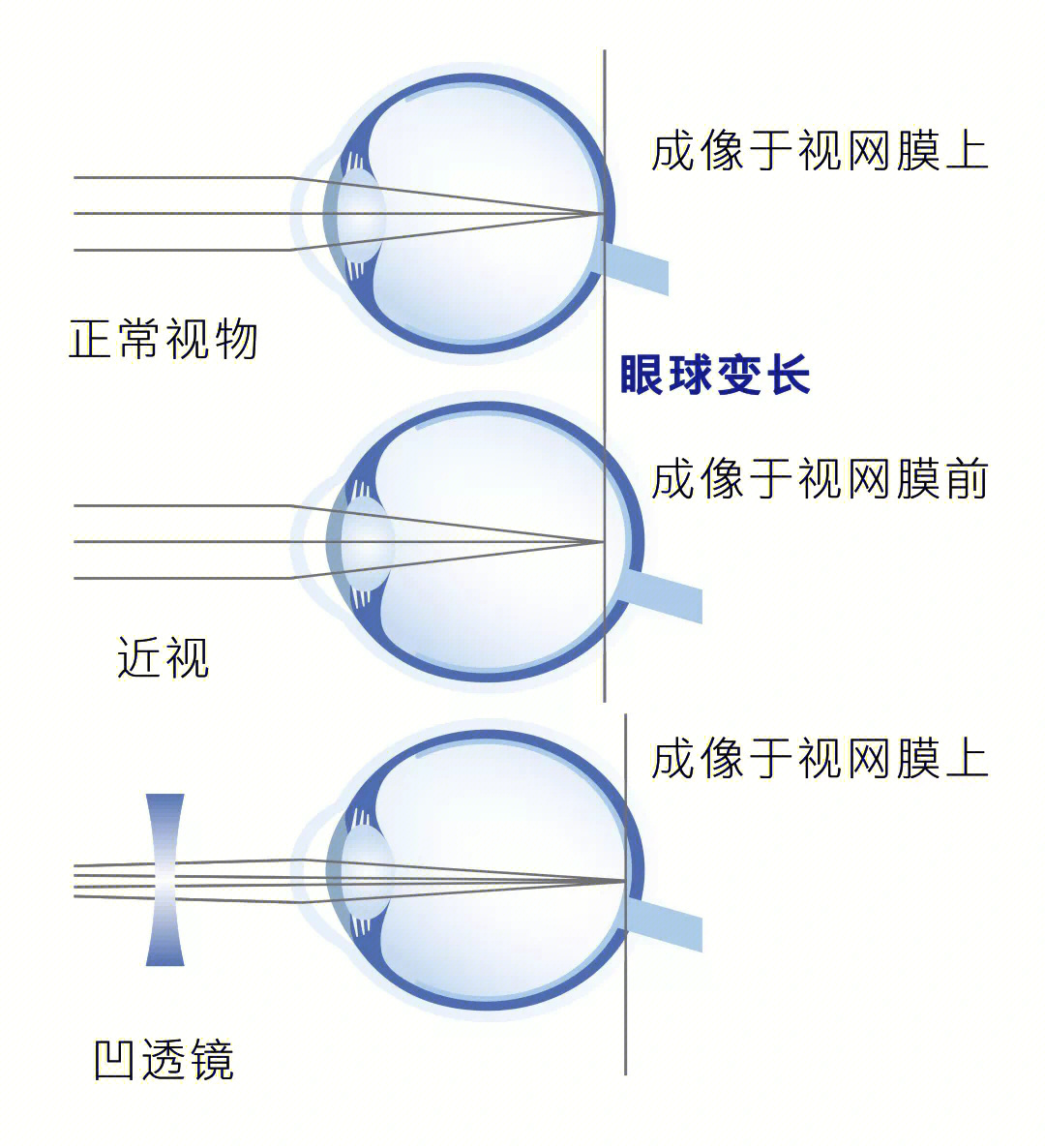 近视眼视网膜成像图图片