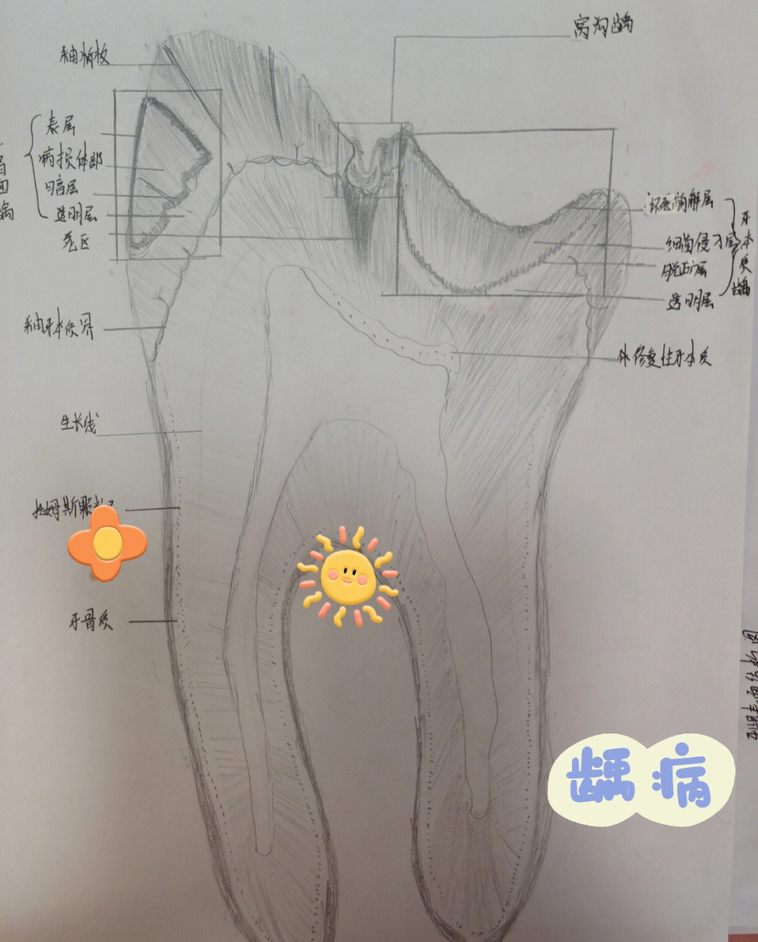 釉牙本质界绘图图片