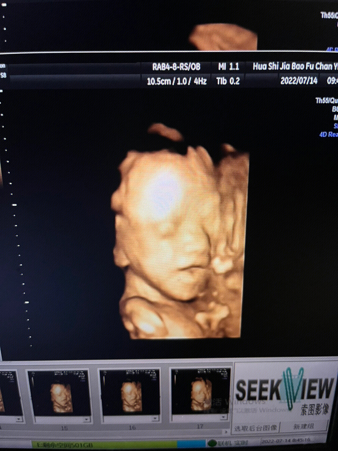 胎儿六个月四维彩超图片