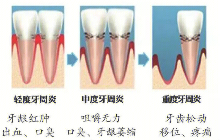 牙槽骨增生有什么危害图片