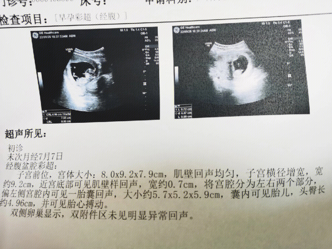 胎芽9mm图片